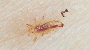 Suspicion of head lice